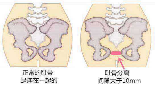 耻骨高最新研究与进展概览