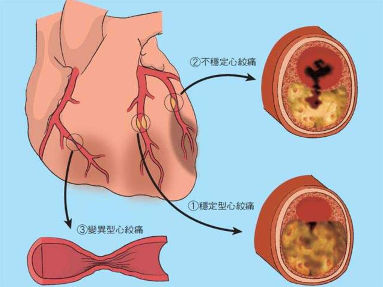 冠心病最新图像研究揭秘，临床意义与应用前景