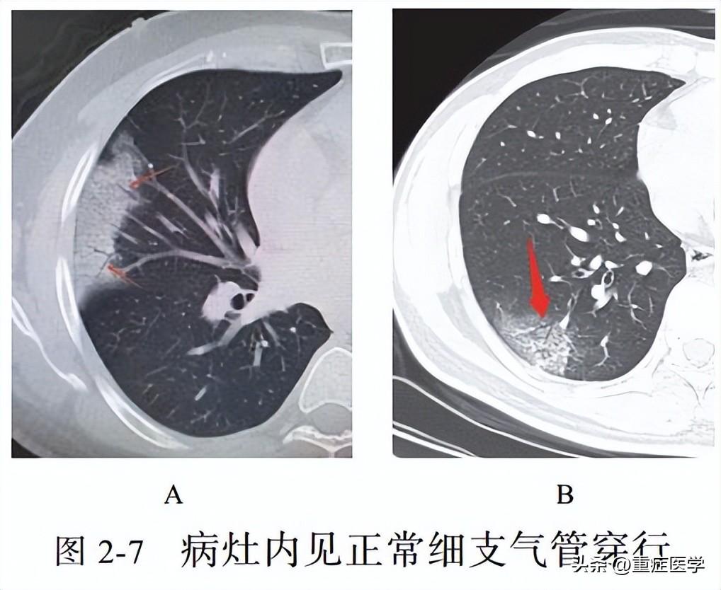 成都新冠状肺炎最新分布概况概览